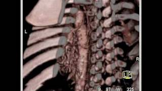 Cardiac prior repair of a coarctation of the aorta 5 of 7 [upl. by Swift856]