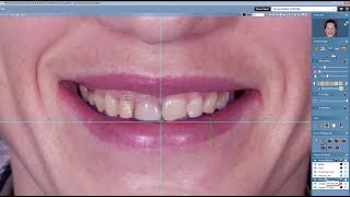 Planmeca Romexis Smile Design – New Features in version 4 6 [upl. by Bekaj935]