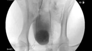 Intraarterial Chemotherapy [upl. by Eupheemia]