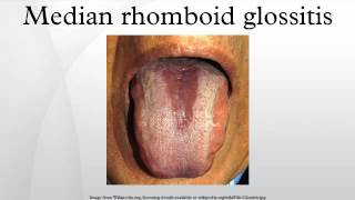 Median rhomboid glossitis [upl. by Eussoj]