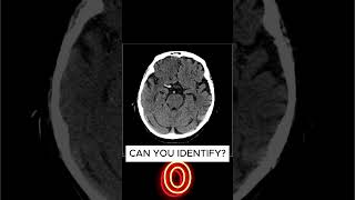 Hyperdense MCA sign Middle Cerebral Artery Strok [upl. by Ahsiakal]