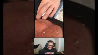 Gushing Back Cyst Pop pimple pimplepop blackhead whitehead shorts [upl. by Ahcsat866]