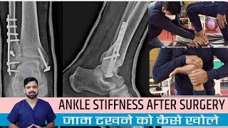 Stiff ankle after surgery exercises in hindi  Ankle fracture physiotherapy exercise amp mobilization [upl. by Dnomal]