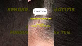 Seborrheic Dermatitis How to treat your Scalp itchyscalp shorts dandruff seborrheicdermatitis [upl. by Leontine]