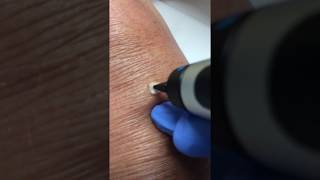 Wratjes verwijderen met cryopen [upl. by Midan]