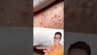 EXTREME BLACKHEAD REMOVAL  Blackhead Popping At Its Best shorts [upl. by Peisch]