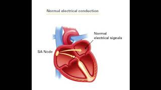 Sick sinus syndrome [upl. by Refinnej32]