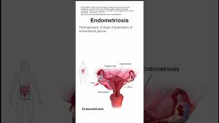 Endometriosis [upl. by Gosselin]