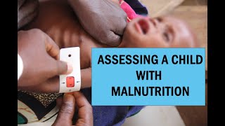 The signs looked for in a child with malnutrition [upl. by Desberg]