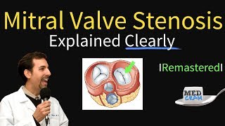 Mitral Valve Stenosis Diagnosis Treatment Pathophysiology [upl. by Acir]