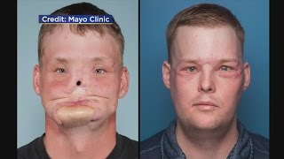 Mayo Surgeons Seeing Amazing Results From First Face Transplant [upl. by Akiemahs]