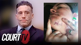 He Bit My Face Wade Wilsons ExGirlfriend Describes Alarming Attack [upl. by Nytsrik]