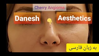 چطور می‌توان خال قرمز رنگ یا توده عروقی خوش خیم پوستی را ظرف کمتر از یک دقیقه برداشت؟ [upl. by Ahtelra250]