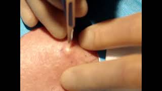 Skin surgery  epidermoid sebaceous cyst removal 1 [upl. by Calvinna]