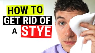 How to Get Rid of a Stye FAST  Chalazion VS Stye Treatment [upl. by Risay]