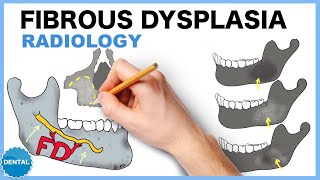 Fibrous dysplasia Radiology [upl. by Lenod]