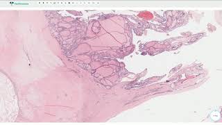 Multinodular Goiter  Thyroid Gland Histopathology [upl. by Gnilrets]