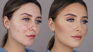 How to treat acne scars 2018 guide by Dermatologist [upl. by Ytok]