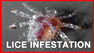 How to Avoid Pubic Lice or Crabs [upl. by Anaela]