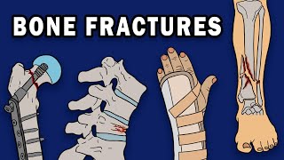 BONE FRACTURES [upl. by Jentoft]