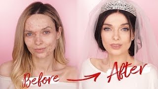 MEGHAN MARKLE WEDDING MAKEUP TUTORIAL  ACNE COVERAGE  MyPaleSkin [upl. by Willing764]