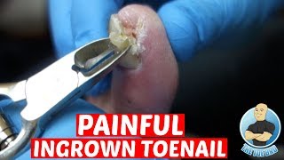 EXTREME PAINFUL INGROWN TOENAIL REMOVALDID IT HURT TO REMOVE IT [upl. by Kenta232]