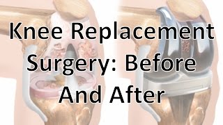 Knee Replacement Surgery Before And After [upl. by Aleetha]