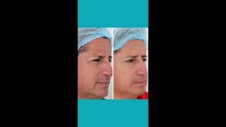 ANTES Y DESPUES BOTOX [upl. by Esaj]