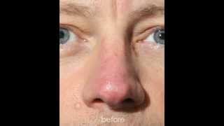 Couperose of the Nose Intense Pulsed Light IPL Treatment [upl. by Lekcar]