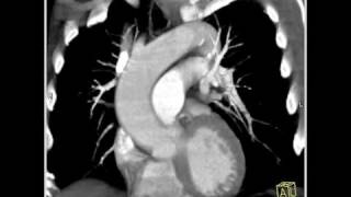 4D Imaging of the Aortic Valve Dilated aortic root 1 of 6 [upl. by Emia]