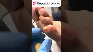 5th toe corn and callus removal by podiatrist satisfyjng to watch but very painfulhave [upl. by Etteval]