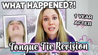 Adult TONGUE TIE RELEASE Update  What happened [upl. by Levina]