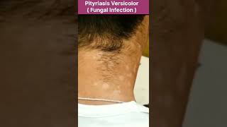 pityriasis versicolar [upl. by Braun]