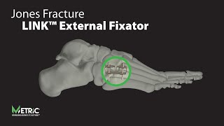 Jones Fracture using LINK™ External Fixator [upl. by Desdamonna31]