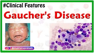 Gauchers Disease Etiology Types Clinical Features Pathogenesis Diagnosis and Treatment [upl. by Julius]