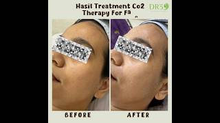 Hasil Treatment Co2 Carboxy Therapy For Face dr3aestheticpractice dr3skincare skintreatment [upl. by Alyahsal]