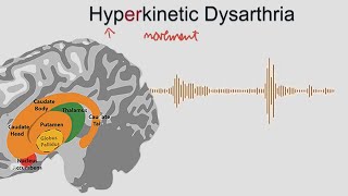 Hyperkinetic Dysarthria  samples and explanation [upl. by Acyre811]