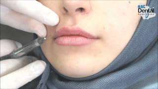 حقن الشفاه بالفيلر  دعامر قنباز  DrAmer Kunbaz  Lip Augmentation  Filler injection [upl. by Nomelif]