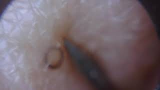 Ingrown hair unravelled and removed [upl. by Ariait842]