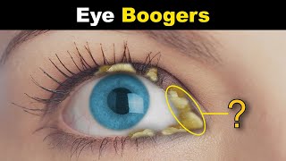 What Are Eye Boogers  Eye Discharge Rheum In Eyes [upl. by Eugaet656]