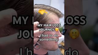 Best hair loss transformation [upl. by Nenerb]