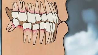 Dental Implants Pros amp Cons  YOU MUST SEE IT [upl. by Kerri]