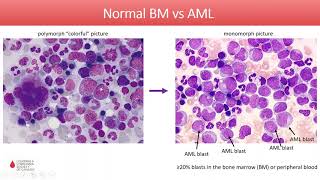 Acute Myeloid Leukemia  Diagnosis and Treatment in 2020 [upl. by Ydur]