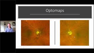 Using the RETeval ERG for Glaucoma w Dr Mike Cymbor OD [upl. by Altman506]