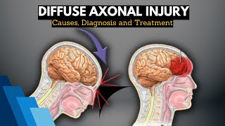 Diffuse Axonal Injury Causes Signs and Symptoms Diagnosis and Treatment [upl. by Hinch90]