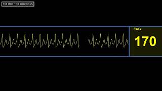 Supraventricular Tachycardia SVT Rhythm Waveform  Simulated Patient Waveform [upl. by Strephon]