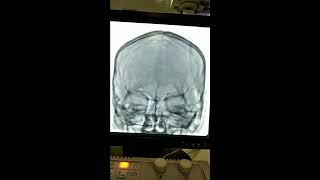 Cerebral Angiography Procedure [upl. by Felix]