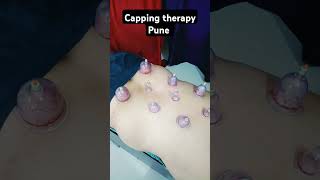 Aman Cupping Therapy back pain relief Capping therapy therapy [upl. by Anivlem]