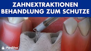 Zahnextraktionen – Behandlung zum Schutze des Zahnfaches © [upl. by Glad]