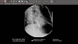 FL Esophagram  Search Pattern [upl. by Deerc68]